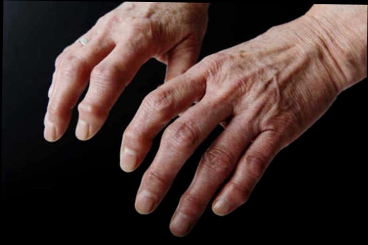 Achat remède de grand-mère pour arthrose des doigts
